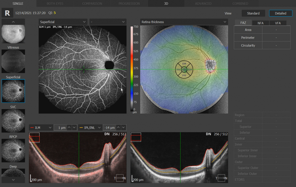 OCT-A retina angiografi – blodgjennomstrømning