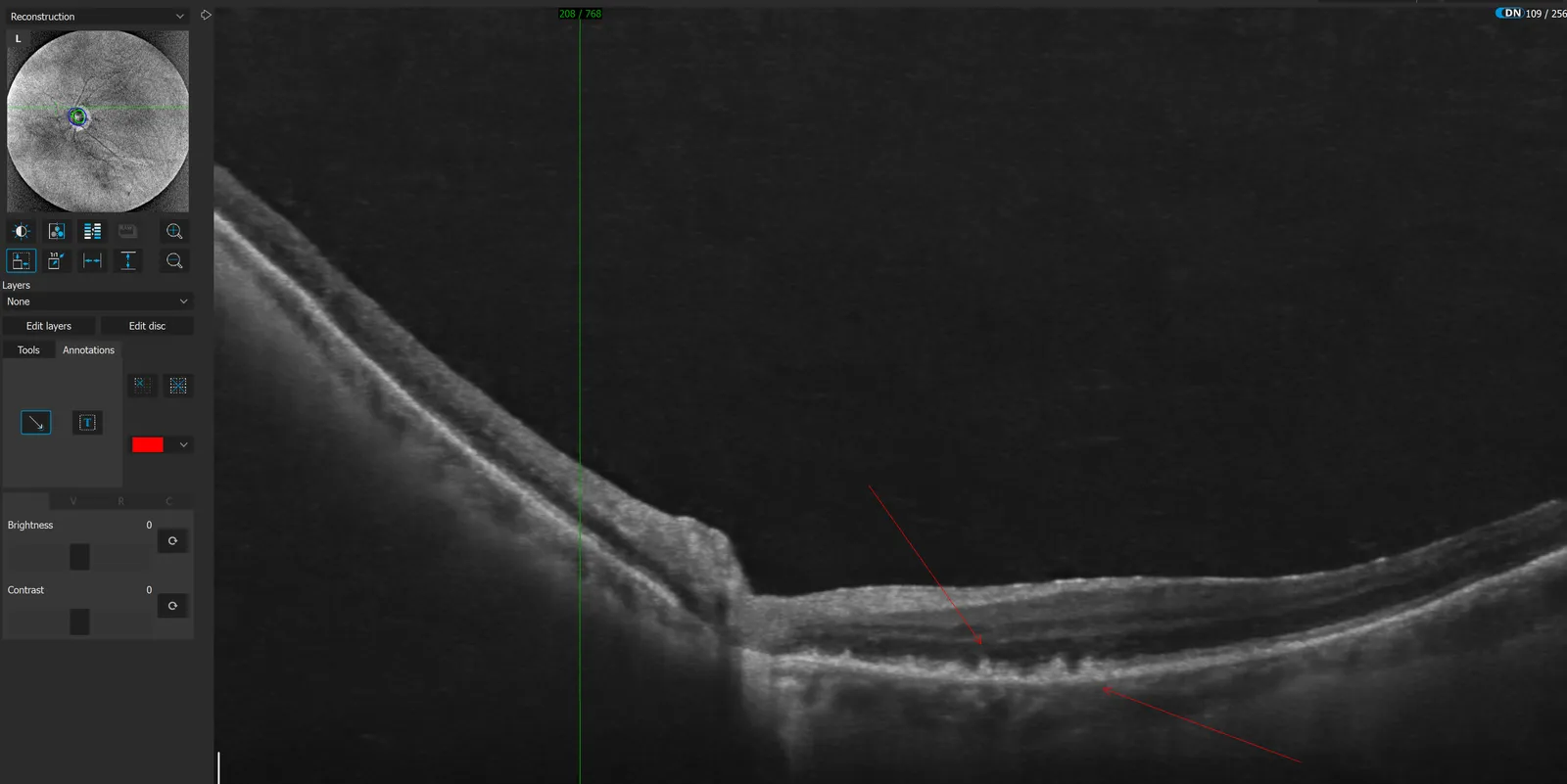 AMD makuladegenerasjon undersøkelse – SmartLook Optikk Sørumsand
